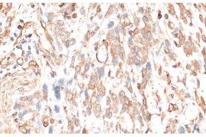 Immunohistochemistry of paraffin-embedded Human gastric cancer using CDH11 Polyclonal Antibody at dilution of 1:100 (40x lens). (OB Cadherin antibody)