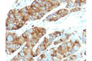 Formalin-fixed, paraffin-embedded human prostate carcinoma stained with LAMP3 antibody (LAMP3/968) (LAMP3 antibody)