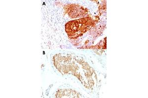 Immunohistochemical staining (Formalin-fixed paraffin-embedded sections) of human colon carcinoma (A) and human testicular carcinoma (B) with ALDH1A1 monoclonal antibody, clone ALDH1A1/1381 .