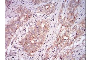 Immunohistochemical analysis of paraffin-embedded cervical cancer tissues using MSTN mouse mAb with DAB staining. (MSTN antibody  (AA 24-266))