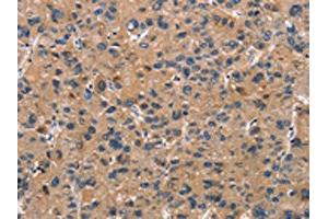 The image on the left is immunohistochemistry of paraffin-embedded Human liver cancer tissue using ABIN7189936(ATP7A Antibody) at dilution 1/50, on the right is treated with synthetic peptide. (ATP7A antibody)