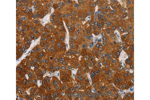 Immunohistochemistry of Human thyroid cancer using CARD9 Polyclonal Antibody at dilution of 1:70 (CARD9 antibody)