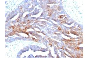 IHC staining of human ovarian carcinoma with TAG-72 antibody (TAG-72 antibody)