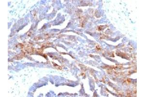 IHC staining of human ovarian carcinoma with TAG-72 antibody (TAG-72 antibody)