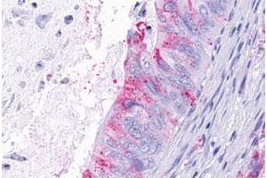 Immunohistochemistry (Formalin/PFA-fixed paraffin-embedded sections) of human colon cancer, neoplastic cells with GPR124 polyclonal antibody . (GPR124 antibody  (Extracellular Domain))
