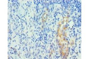 Immunohistochemistry of paraffin-embedded human lung cancer using ABIN7150963 at dilution of 1:100 (PIAS1 antibody  (AA 422-651))