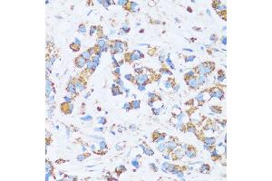 Immunohistochemistry of paraffin-embedded human breast cancer using C antibody (ABIN7266074) at dilution of 1:100 (40x lens). (CA13 antibody  (AA 1-220))