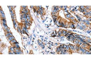 Immunohistochemistry of paraffin-embedded Human colon cancer using Claudin 7 Polyclonal Antibody at dilution of 1:50 (Claudin 7 antibody)