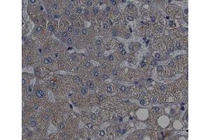 ABIN6267439 at 1/200 staining human liver cancer tissue sections by IHC-P. (RPS6KB1 antibody  (pThr389, pThr412))