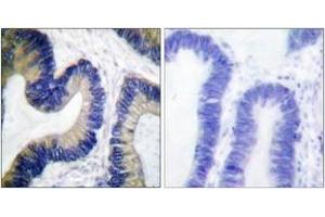 Immunohistochemistry analysis of paraffin-embedded human colon carcinoma, using 4E-BP1 (Phospho-Ser64) Antibody. (eIF4EBP1 antibody  (pSer64))