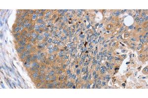 Immunohistochemistry of paraffin-embedded Human esophagus cancer using REG3A Polyclonal Antibody at dilution of 1:40 (REG3A antibody)