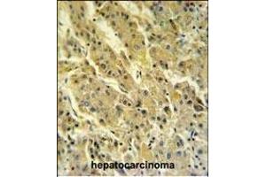 PSG7 Antibody (C-term) (ABIN651132 and ABIN2840089) IHC analysis in formalin fixed and paraffin embedded hepatocarcinoma followed by peroxidase conjugation of the secondary antibody and DAB staining. (PSG7 antibody  (C-Term))
