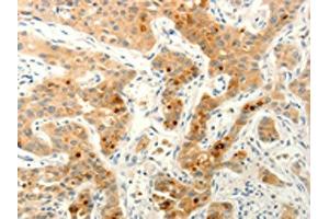 The image on the left is immunohistochemistry of paraffin-embedded Human lung cancer tissue using ABIN7190632(FAT4 Antibody) at dilution 1/20, on the right is treated with synthetic peptide. (FAT4 antibody)