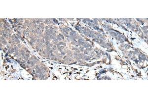 Immunohistochemistry of paraffin-embedded Human thyroid cancer tissue using UPK3A Polyclonal Antibody at dilution of 1:30(x200) (Uroplakin 3A antibody)