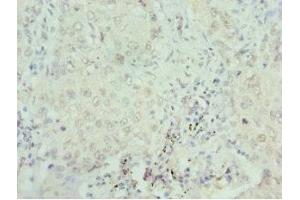 Immunohistochemistry of paraffin-embedded human lung cancer using ABIN7168762 at dilution of 1:100 (SEPHS1 antibody  (AA 1-392))
