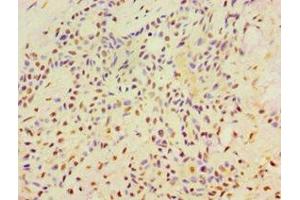 Immunohistochemistry of paraffin-embedded human breast cancer using ABIN7169355 at dilution of 1:100 (SRRT antibody  (AA 627-876))