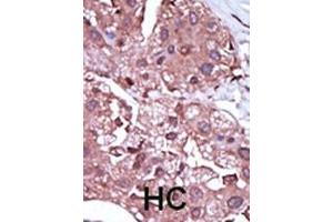 Formalin-fixed and paraffin-embedded human cancer tissue reacted with the primary antibody, which was peroxidase-conjugated to the secondary antibody, followed by DAB staining. (ACVRL1 antibody  (C-Term))