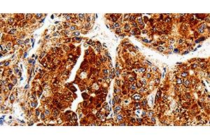 Immunohistochemistry of paraffin-embedded Human liver cancer tissue using COX19 Polyclonal Antibody at dilution 1:50 (COX19 antibody)