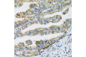 Immunohistochemistry of paraffin-embedded human gastric cancer using TXN2 antibody (ABIN5974110) at dilution of 1/100 (40x lens). (TXN2 antibody)