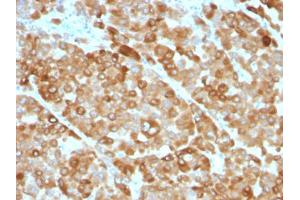 Immunohistochemical staining (Formalin-fixed paraffin-embedded sections) of human melanoma with TYR monoclonal antibody, clone OCA1/812 . (TYR antibody)