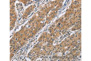 Immunohistochemistry of Human gastric cancer using COPB1 Polyclonal Antibody at dilution of 1:50 (COPB1 antibody)