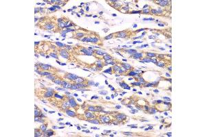 Immunohistochemistry of paraffin-embedded human colon carcinoma using TXN2 antibody at dilution of 1:100 (x40 lens). (TXN2 antibody)