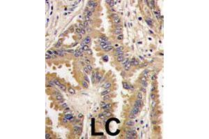 Formalin-fixed and paraffin-embedded human lung carcinoma tissue reacted with BAD polyclonal antibody  , which was peroxidase-conjugated to the secondary antibody, followed by DAB staining.