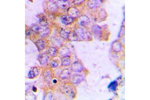 Immunohistochemical analysis of ACAT1 staining in human lung cancer formalin fixed paraffin embedded tissue section. (ACAT1 antibody  (Center))