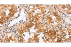 Immunohistochemistry of paraffin-embedded Human thyroid cancer using CRELD2 Polyclonal Antibody at dilution of 1:50 (CRELD2 antibody)
