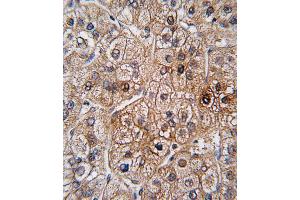 Formalin-fixed and paraffin-embedded human hepatocarcinoma tissue reacted with BMPR2 antibody (N-term), which was peroxidase-conjugated to the secondary antibody, followed by DAB staining. (BMPR2 antibody  (N-Term))