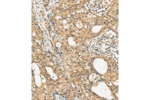 (ABIN392009 and ABIN2837977) staining c-KIT in human breast carcinoma tissue sections by Immunohistochemistry (IHC-P - paraformaldehyde-fixed, paraffin-embedded sections). (KIT antibody  (AA 912-941))
