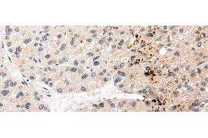 Immunohistochemistry of paraffin-embedded Human liver cancer tissue using AQP11 Polyclonal Antibody at dilution 1:30 (AQP11 antibody)