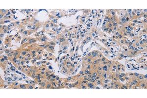Immunohistochemistry of paraffin-embedded Human lung cancer tissue using CASP10 Polyclonal Antibody at dilution 1:30 (Caspase 10 antibody)