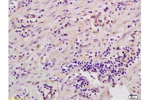 Formalin-fixed and paraffin embedded human gastric carcinoma labeled with Anti-MSK1/RPS6KA5 Polyclonal Antibody, Unconjugated  at 1:200 followed by conjugation to the secondary antibody and DAB staining. (Msk1/2 (AA 49-94) antibody)