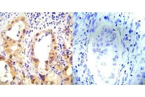 Immunohistochemical analysis of paraffin-embedded human lung carcinoma tissue using P53 (phospho-Ser37) antibody (E012031).