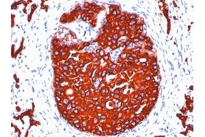 Formalin-fixed, paraffin-embedded human Breast Carcinoma stained with Cytokeratin, pan Monoclonal Antibody cocktail (KRTL/1077 + KRTH/1076). (KRT77, KRT76 antibody)