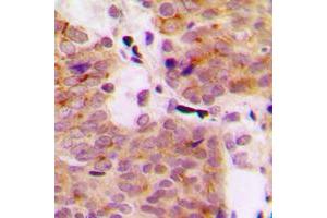 Immunohistochemical analysis of MEKK1 (pT1402) staining in human breast cancer formalin fixed paraffin embedded tissue section. (MAP3K1 antibody  (C-Term, pSer1402))