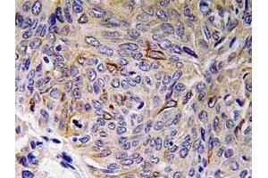 Immunohistochemical analysis of paraffin-embedded human lung cancer tissue using IL32 polyclonal antibody . (IL32 antibody)