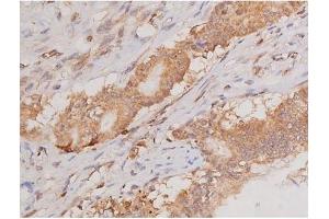 ABIN6269133 at 1/200 staining Human colon cancer tissue sections by IHC-P. (KIT antibody  (Internal Region))