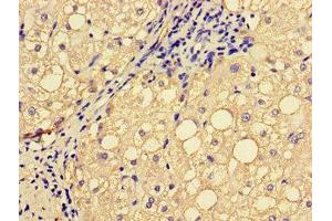 Immunohistochemistry of paraffin-embedded human liver cancer using ABIN7151827 at dilution of 1:100