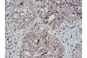 Immunohistochemical staining of paraffin-embedded Adenocarcinoma of Human ovary tissue using anti-PDSS2 mouse monoclonal antibody. (PDSS2 antibody)