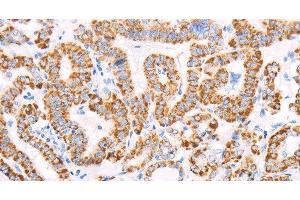 Immunohistochemistry of paraffin-embedded Human thyroid cancer using ATPIF1 Polyclonal Antibody at dilution of 1:50 (ATPase Inhibitory Factor 1 antibody)