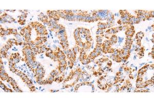 Immunohistochemistry of paraffin-embedded Human thyroid cancer using ATPIF1 Polyclonal Antibody at dilution of 1:50 (ATPase Inhibitory Factor 1 antibody)
