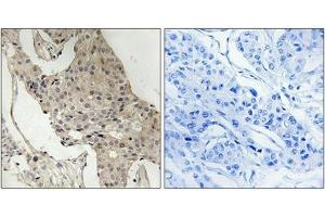 Immunohistochemical analysis of paraffin-embedded human breast carcinoma tissue using Gab2 (Phospho-Ser623) antibody (left)or the same antibody preincubated with blocking peptide (right). (GAB2 antibody  (pSer623))