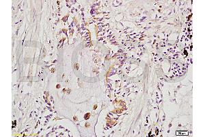 Formalin-fixed and paraffin embedded human lung carcinoma labeled with Rabbit Anti ARHGAP24 Polyclonal Antibody, Unconjugated (ABIN714716) at 1:200 followed by conjugation to the secondary antibody and DAB staining (ARHGAP24 antibody  (AA 501-600))