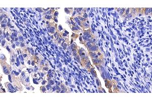 Detection of MMP7 in Human Endometrial cancer Tissue using Polyclonal Antibody to Matrix Metalloproteinase 7 (MMP7) (MMP7 antibody  (AA 1-267))