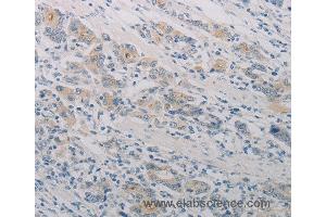 Immunohistochemistry of Human gastic cancer using PTAFR Polyclonal Antibody at dilution of 1:70