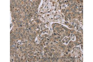 Immunohistochemistry of Human lung cancer using IL15RA Polyclonal Antibody at dilution of 1:45 (IL15RA antibody)