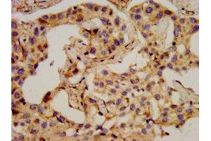 IHC image of ABIN7161261 diluted at 1:400 and staining in paraffin-embedded human liver cancer performed on a Leica BondTM system.