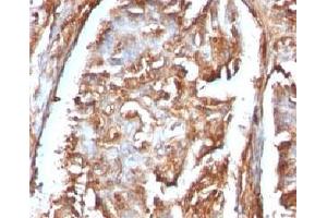 Formalin-fixed, paraffin-embedded human renal carcinoma stained with Beta-2-Microglobulin antibody. (beta-2 Microglobulin antibody)
